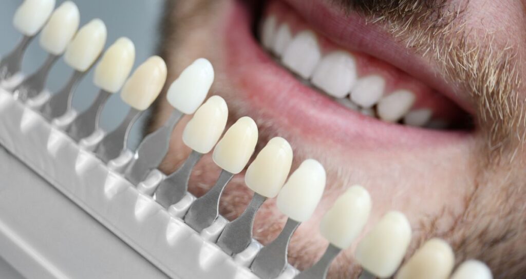 Veneers