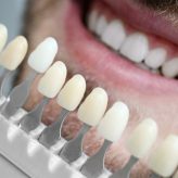 Feature (14) Veneers